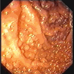 Nodular pattern of jejunal mucosa in giardiasis