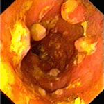 Multiple inflammatory polyps in terminal ileum