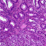Metastasis of the malignant melanoma