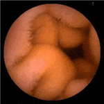 Normal duodenum