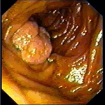 Polyp in jejunum