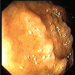 Nodular mucosa in terminal ileum