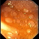 Nodular pattern of jejunal mucosa in giardiasis