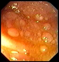 giardiasis endoscopy