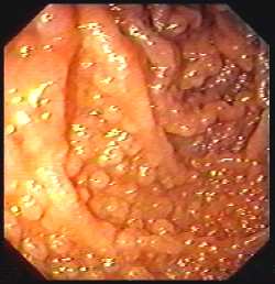 giardia endoscopy paraziták savanyú káposzta