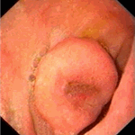 Stromal tumour of duodenum (GIST)