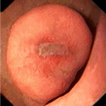 Stromal tumour of duodenum (GIST)