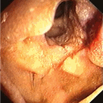 Exophytic tumour of proximal jejunum
