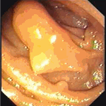 Polypoid jejunal lipoma