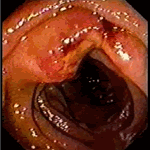 Exulcerated jejunal lymphangioma