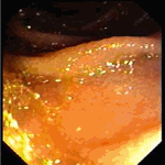 Endoscopic view of abnormal jejunal mucosa