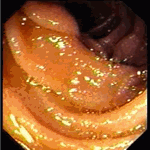 Endoscopic view of abnormal jejunal mucosa