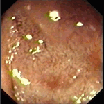 Lipid transport disturbance