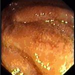 Lipid transport disturbance