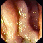 Diffuse intestinal lymphangiectasia