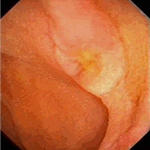 Aphthous ulcer on the top of jejunal fold
