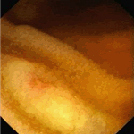An immerse picture of small aphthous ulcer