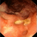 Severe involvement of terminal ileum