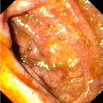 Small bowel involvement before treatment