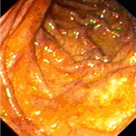 Small bowel involvement before treatment