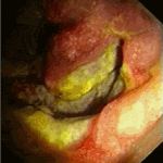Primary mucosal melanoma of duodenum