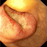 Metastasis of lung non-small adenocarcinoma