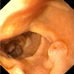 Metastasis of lung non-small adenocarcinoma