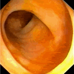 Normal terminal ileum