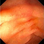 Multiple mucosal petechiae