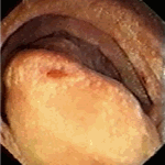 Mucosal erosion in the second loop of jejunum