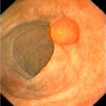 Tubulo-villous adenoma of duodenum