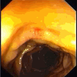 Vascular malformation in jejunum