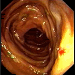 Vascular malformation in jejunum