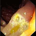 Vascular malformation in jejunum