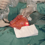 Intraoperative enteroscopy