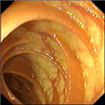 Intraoperative enteroscopy