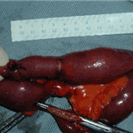 Carcinoid of the ileum