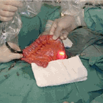 Stromal tumour of the jejunum (GIST)