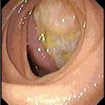 Stromal tumour of the jejunum (GIST)