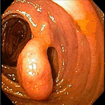 Penduculated hamartoma in the ileum