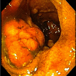 Large ileal hamartoma 