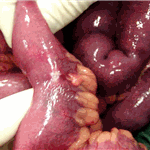 Carcinoid of the ileum