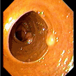 Carcinoid of the ileum