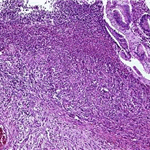Expansively growing spindle cell tumour