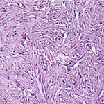 Low cellularity of the tumour