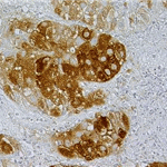 Metastasis of the malignant melanoma