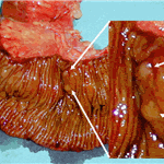 Surgical specimen of resected jejunum