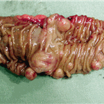 Surgical specimen of resected ileal tumours