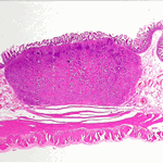 Carcinoid of ileum