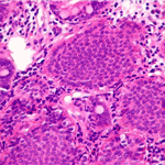 Carcinoid of ileum